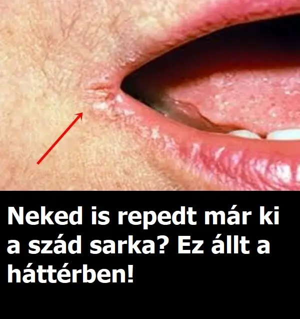 kiszaradt szajsarok 600x381
